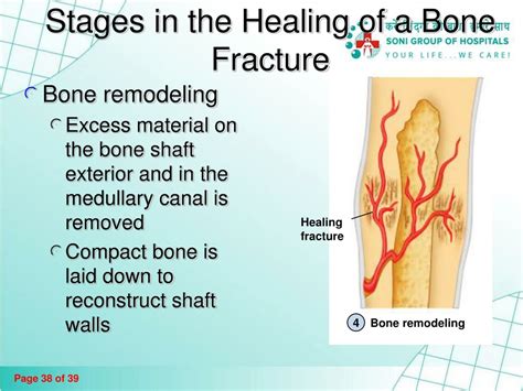 PPT - Fractures and Bone Healing PowerPoint Presentation, free download ...