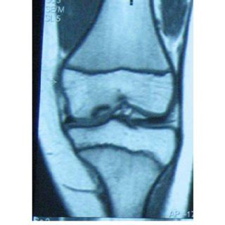 MRI revealed a 2 cm-long defect at the medial femoral condyle at the ...