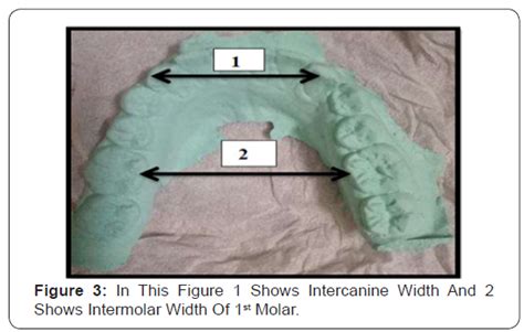 Juniper Publishers Sex Determination Based On Odontometric Analysis Using Discriminant Function