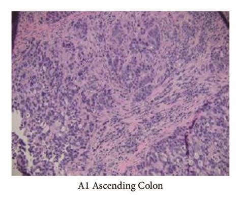 Ascending Colon Biopsy Showing Poorly Differentiated Invasive Download Scientific Diagram