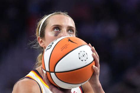 Lexie Hull Breathes Relief After Learning Black Eye Came Without Concussion