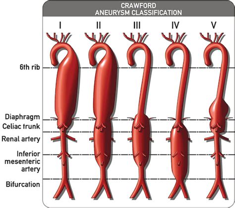 Thoracic Aortic Aneurysm Classification