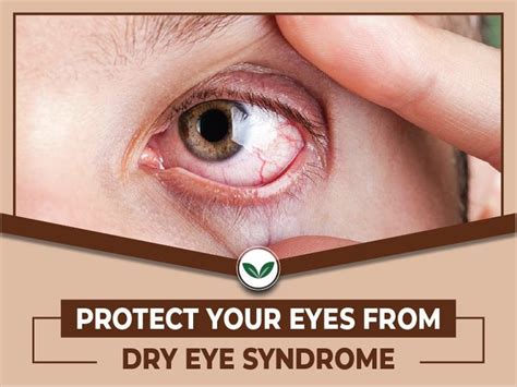 Protect Your Eyes From Dry Eye Syndrome Dry Eye Syndrome Dry Eyes Eyes