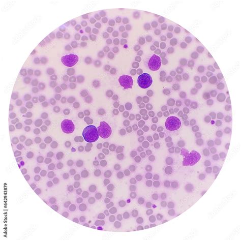 Smudge Cells Gumprecht Shadows Smear Cells Or Basket Cells Are A