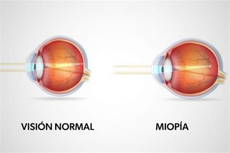 Miopía Qué Es Causas Y Tratamiento Tua Saúde