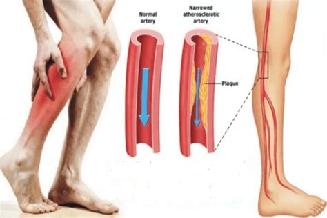 Fibromyalgie Et Crampes Dans Les Jambes Ce Que Vous Devez Savoir