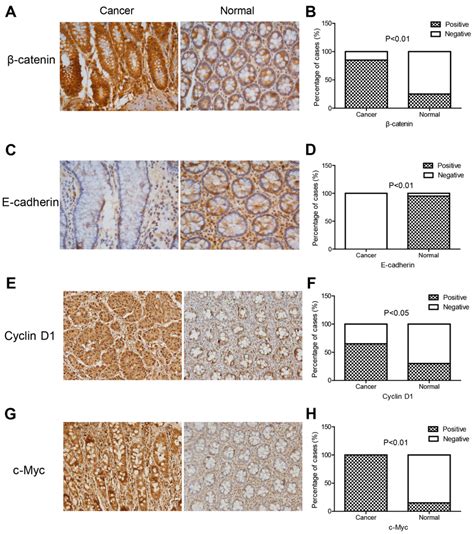 Immunohistochemical staining of E cadherin β catenin cyclin D1 and