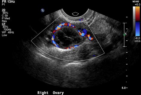 Ovarian Cancer Ultrasound Ovarian Cancer Geeky Medics