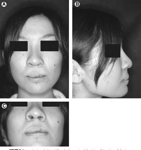 Figure 5 From Secondary Correction Of Bilateral Cleft Lip And Nasal