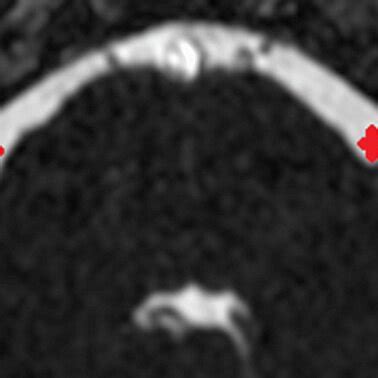 MRI with internal auditory canal protocol demonstrating normal anatomy ...