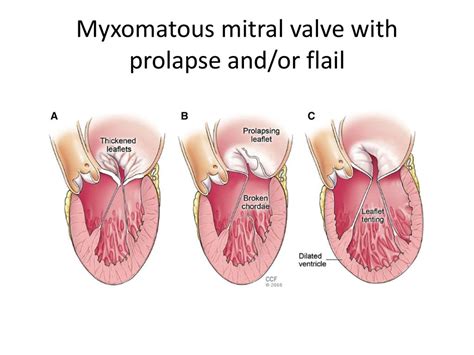 Does mitral valve prolapse go away: Mitral valve prolapse – Symptoms ...