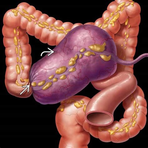 DIAGRAM Diagram Of Cecal Volvulus WIRINGSCHEMA