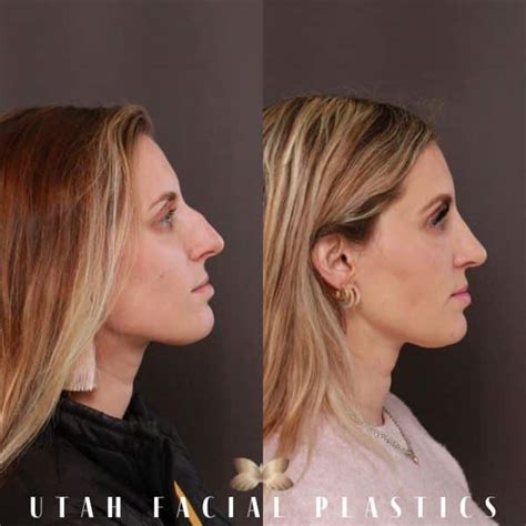 Rhinoplasty Layton Ut Utah Facial Plastics