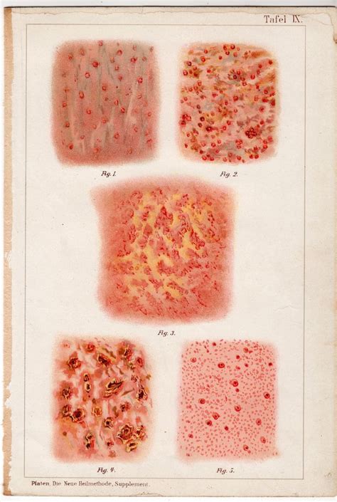 C 1902 SKIN DISEASE PRINT Syphilid Syphilis Infections Etsy