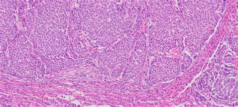 Human Liver Cancer Hepatocellular Carcinoma Ffpe Sections