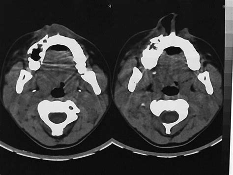 Apparance Of The Alveolar Bone Fracture On Computerized Tomography