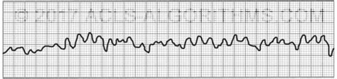 Ventricular Fibrillation ACLS Algorithms