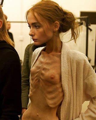 Anorexic Girls Porn Pictures XXX Photos Sex Images 1709122 PICTOA