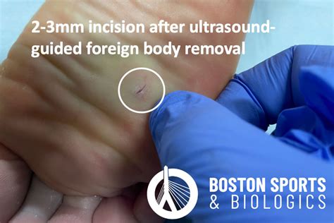Boston Sports The Role Of Regenerative Medicine In Orthopedics