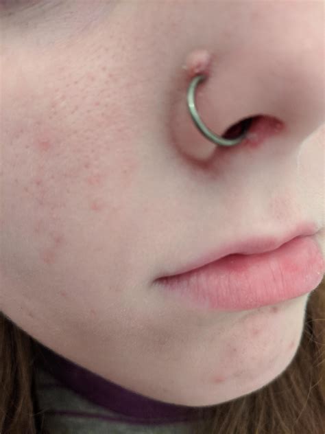 How to get rid of a nose ring bump fast expert tips – Artofit