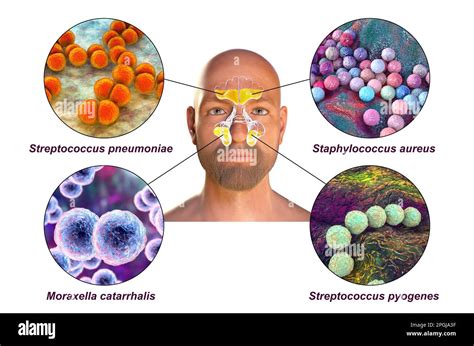 Anatomy Of Rhinosinusitis And Bacteria That Cause Sinusitis