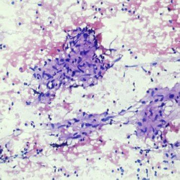 H & E 10X FNAC findings of Chronic Granulomatous Lymphadenitis ...