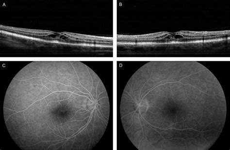 Spectral-domain optical coherence tomography with multiple B-scan ...