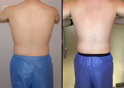 Coolsculpting Before And After Pictures In Nyc Skinney Medspa