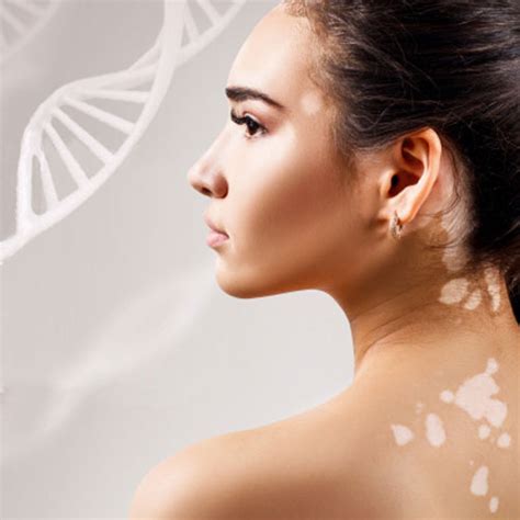 Is Vitiligo Hereditary Vitiligo Treatment South Africa