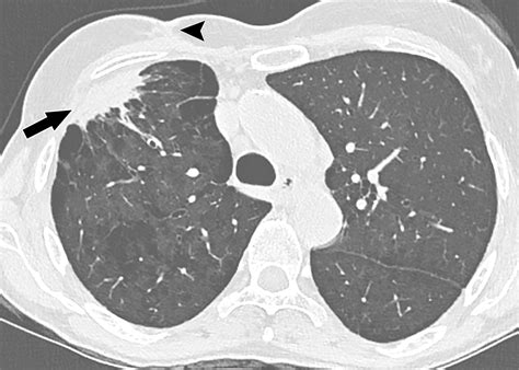 Recognizing Radiation Therapy Related Complications In The Chest Radiographics