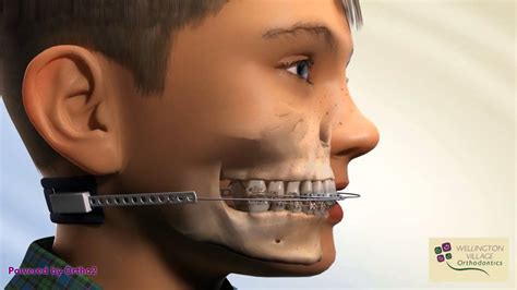 cervical pull headgear orthodontics  isabella embry blog