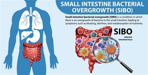 SIBO: The condition explained — Tania Wells - Naturopath Health ...