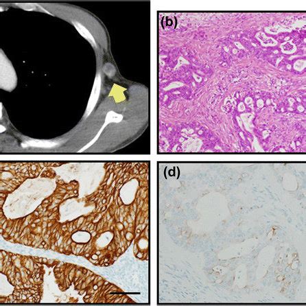 An Excisional Biopsy Of Axillary Lymph Node CT A Detected A Swollen