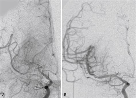 Endovascular Management Of Chronic Cerebral Ischemia Clinical Tree