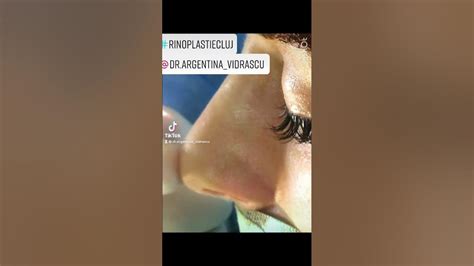 Septoplasty Rhinoplasty Septorhinoplasty Always Together Youtube