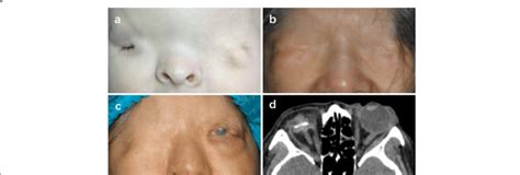 A Case 4 One Month Old Boy With Complete Cryptophthalmos Os And