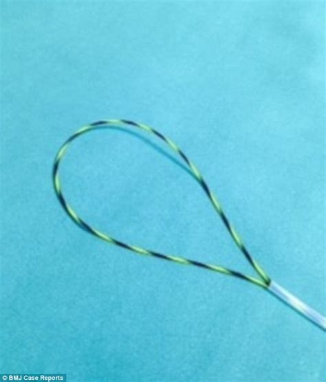 Might Be A World Record For Largest Dildo Lost Up A Butt Radio Gunk