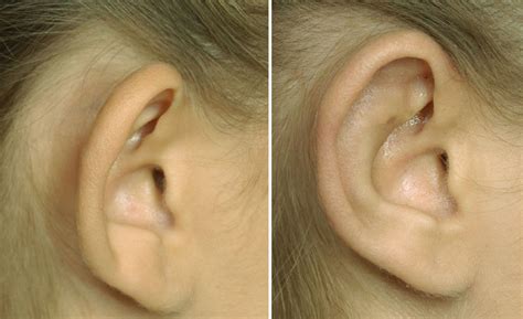 Plastic Surgery Case Study Otoplasty Surgery For Protruding Ears