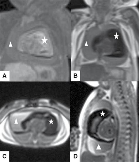 A Case Of Fetal Cardiac Rupture Diagnosed By Postmortem Magnetic