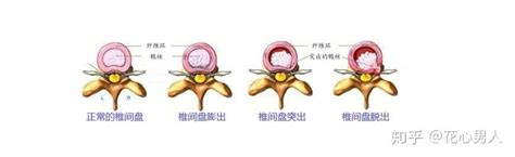 如何治疗腰椎间盘突出 治腰椎间盘突出的药 知乎