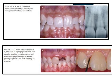 Diagnosis Of Periodontal Diseases Pdf