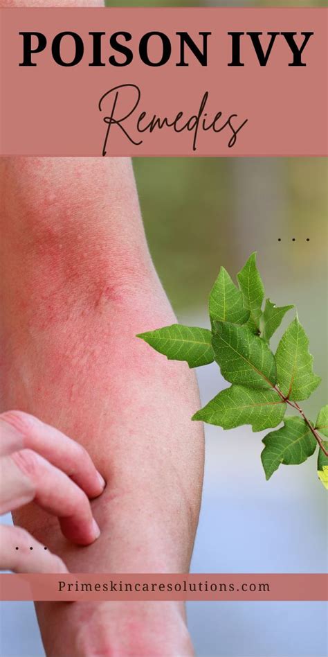 Poison Ivy Remedies