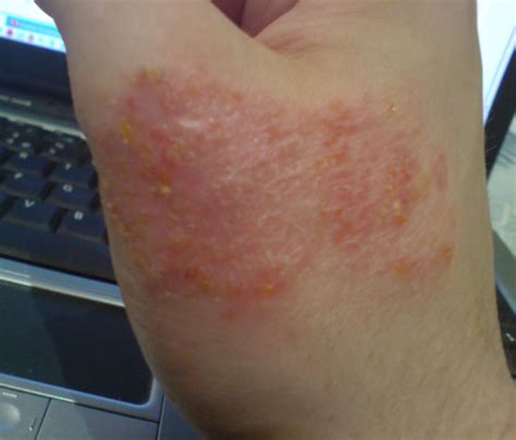 Eczema Symptoms Pictures - Eczema Treatment: Eczema Symptoms Pictures