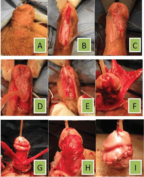 A Penile Torsion Before Operation B Making Midline Incision C