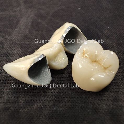 Oral Health Long Term Restoration Pfm Dental Metal Ceramic Crown Glazed