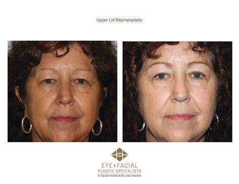 Upper Lid Blepharoplasty | San Antonio, TX