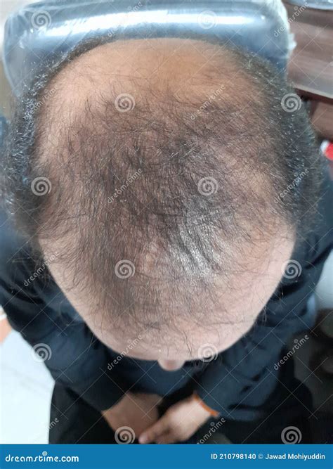 A Bald Spot On Man`s Head Indicating The Hair Loss Pattern Stock Photo