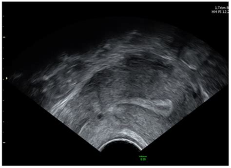 Jpm Free Full Text Laparoscopic Management Of Cesarean Scar