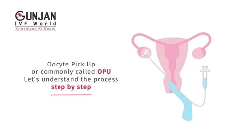 opu pickup     gunjan ivf world