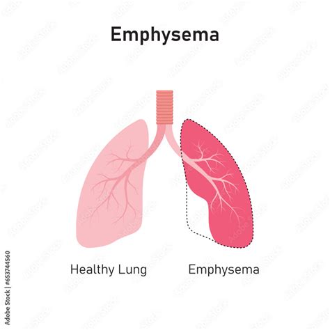 Emphysema Lung Disease Concept Design. Vector Illustration. Stock ...